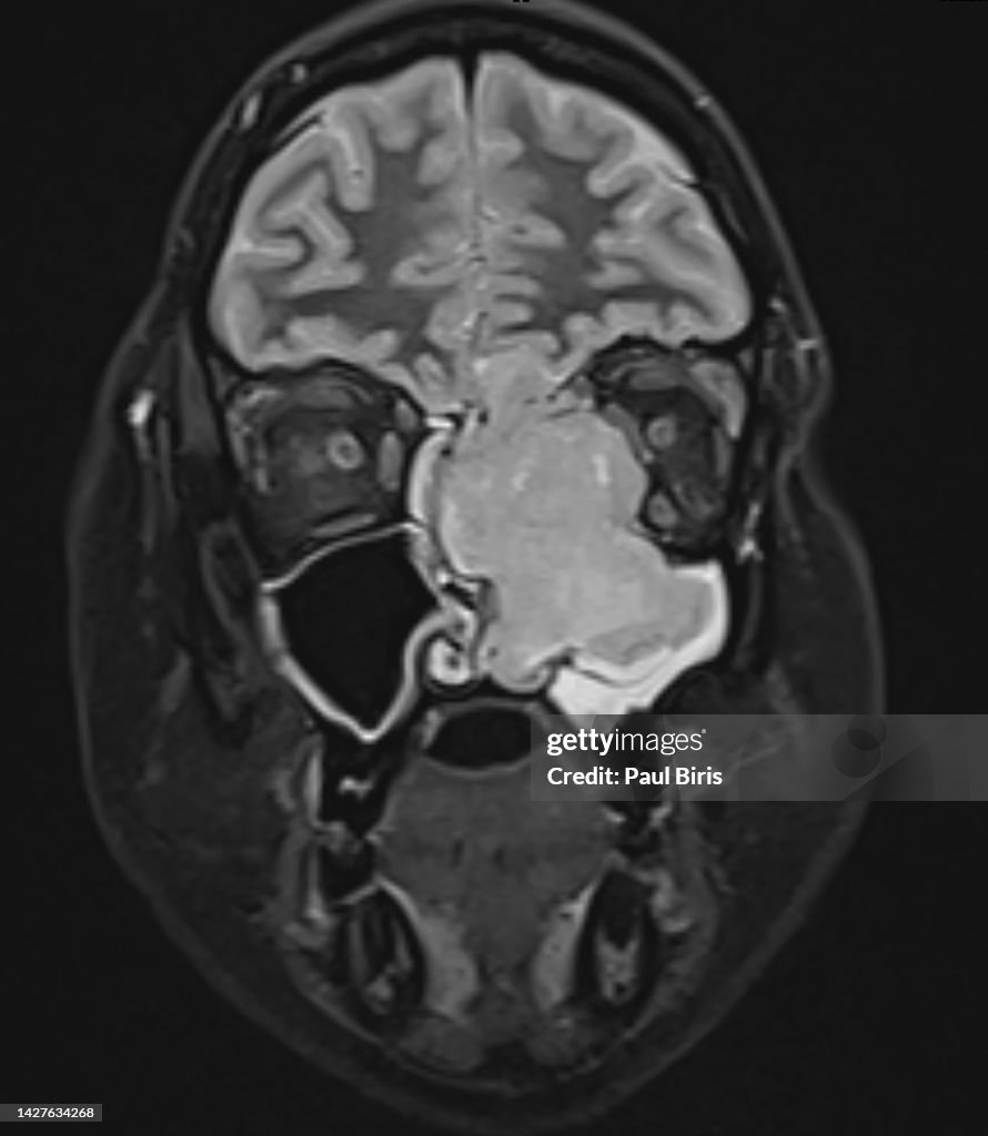 Olfactory neuroblastomas seen on MRI (magnetic resonance imaging), coronal STIR image