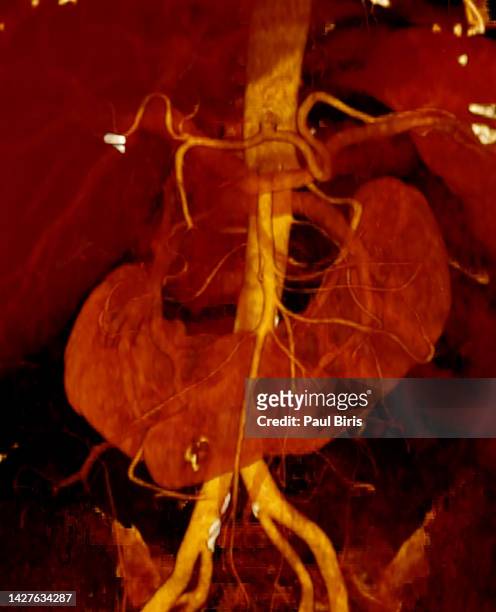 horseshoe kidneys seen on 3d reconstruction on ct scan - ct angiography stock pictures, royalty-free photos & images