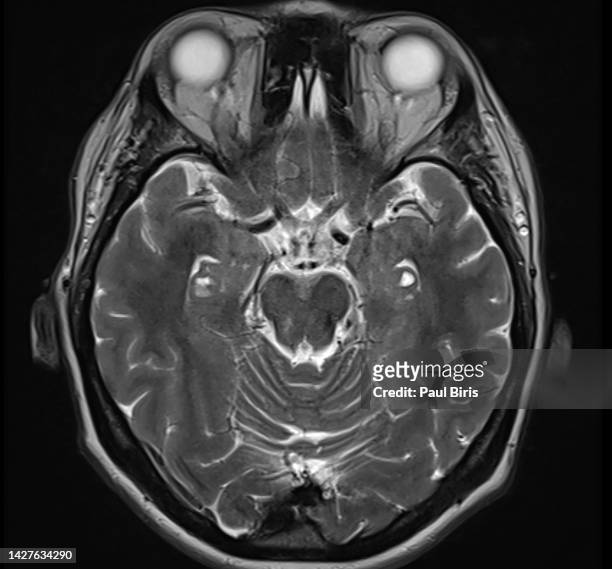 hippocampal sulcus remnant cysts seen on t2 axial mri (magnetic resonance imaging) - amygdala stock pictures, royalty-free photos & images