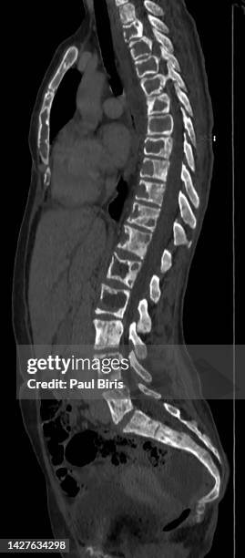 fibrous dysplasia and mccune–albright syndrome, ct computer tomography image - tumour stock pictures, royalty-free photos & images