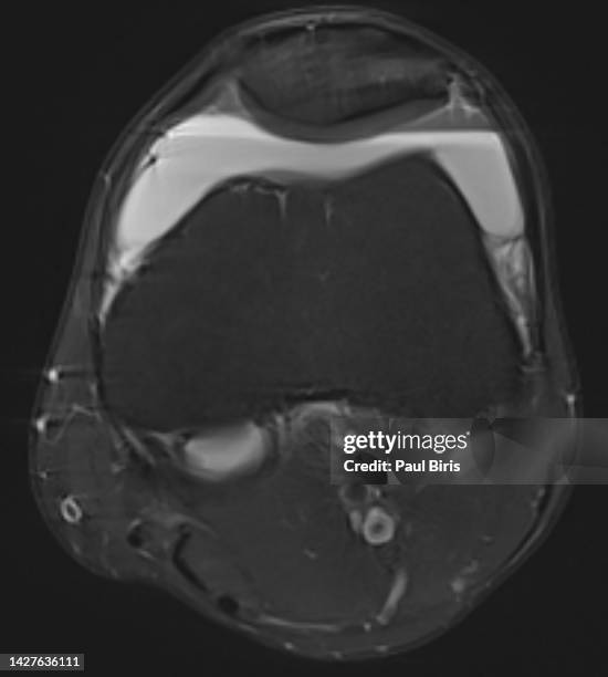 mr imaging of lipohaemarthrosis in knee joint, axial view magnetic resonance - hemorrhage stock pictures, royalty-free photos & images