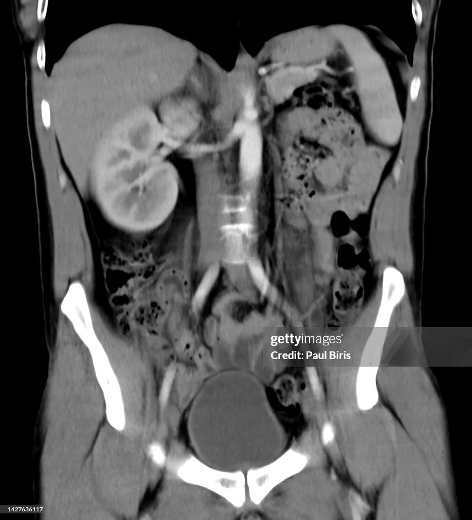 Unilateral renal agenesis (URA) seen on coronal CT computer tomografy image