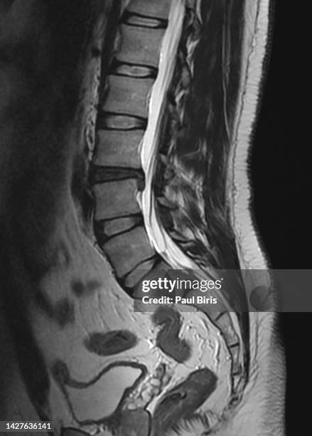 magnetic resonance image - vertebrae of spine with one herniated disc l3-l4 that presses on the spinal cord - herniated disc 個照片及圖片檔