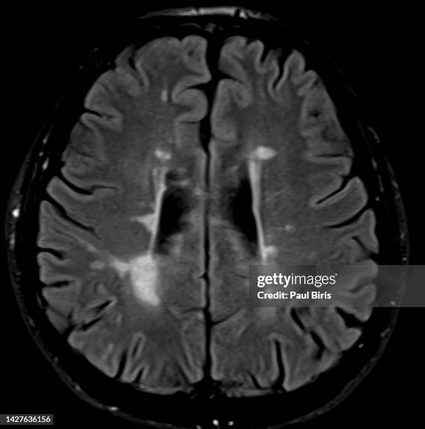 magnetic resonance imaging (mri) of multiple sclerosis in brain, axial flair image - mri of multiple sclerosis stock pictures, royalty-free photos & images