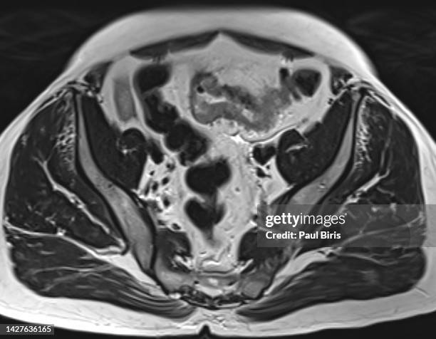 local staging of sigmoid colon cancer using mri, axial t2 image - cólon sigmoide imagens e fotografias de stock