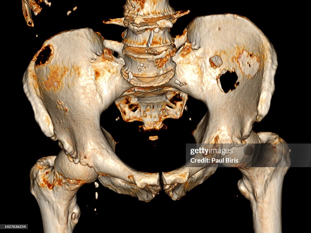 Multiple osteolytic metastases seen on CT Scan of pelvic bone with both hip joint 3D rendering image