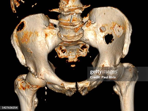 multiple osteolytic metastases seen on ct scan of pelvic bone with both hip joint 3d rendering image - tumore metastatico foto e immagini stock