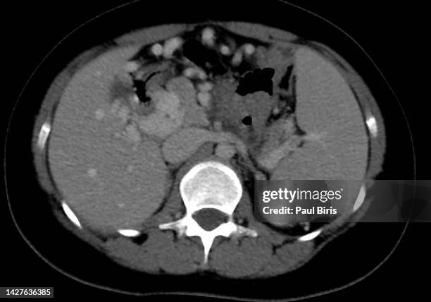 varices in portal hypertension: evaluation with ct. the portosystemic collateral channels - cirrhosis bildbanksfoton och bilder