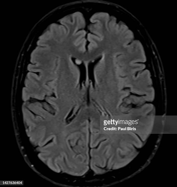 brain mri scan. ring-shaped lateral ventricular nodules: a “leave me alone” lesion  (rslvns) - cerebrum stock-fotos und bilder