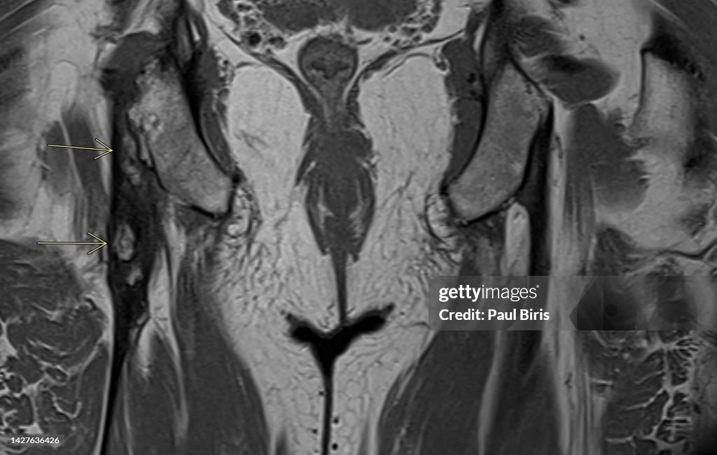 High Hamstring Mri T1 Appearance Of The Proximal Hamstring Tendinopathy With ...