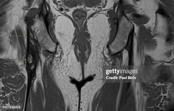 1,554 Hamstring Injury Stock Photos, High-Res Pictures, and Images ...