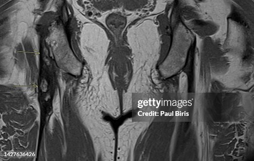 MRI T1 Appearance of the Proximal Hamstring Tendinopathy with calcification (arrows) MRI T1 Appearance of the Proximal Hamstring Tendinopathy with calcification (arrows)