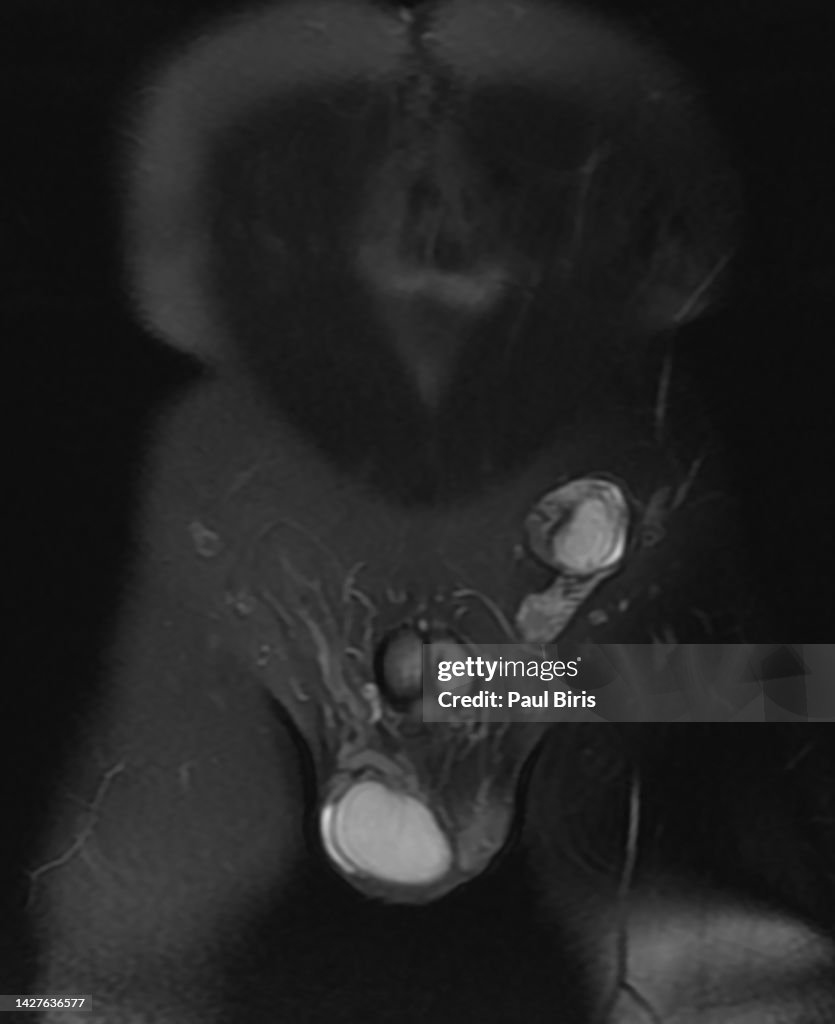 Left undescended testis, cryptorchidism, MRI Magnetic resonance imaging, Coronal view
