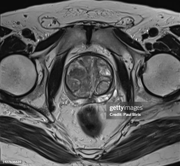benign prostate hypertrophy (mri), axial t2 image - psa stock pictures, royalty-free photos & images