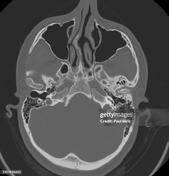 confirmation of the nasal septum deviation (nsd) severity by computed tomography (ct) - head wound stock pictures, royalty-free photos & images