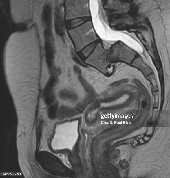 illustration of slipped lumbosacral vertebra or spondylolithesis on mri image (magnetic resonance imaging) - degenerative disc disease stock pictures, royalty-free photos & images