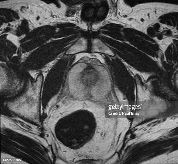 mri features of the normal prostatic peripheral zone, axial t2 smal fov mri image - cancer de piel stockfoto's en -beelden