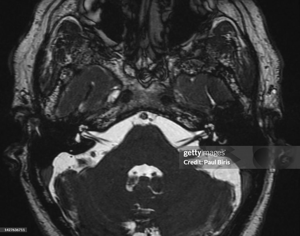 Anatomy Of The Inner Ear And Internal Auditory Canal Mri Of The Inner ...