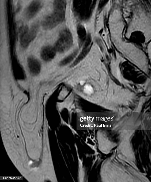 diagnosis of inguinal region hernias with sagittal t2 mri image - hernia inguinal ストックフォトと画像