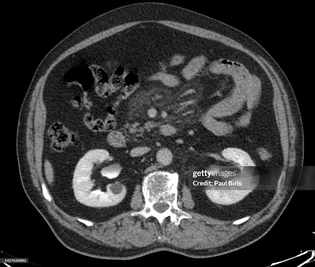 CT Findings in Sclerosing Mesenteritis (Panniculitis), axial view