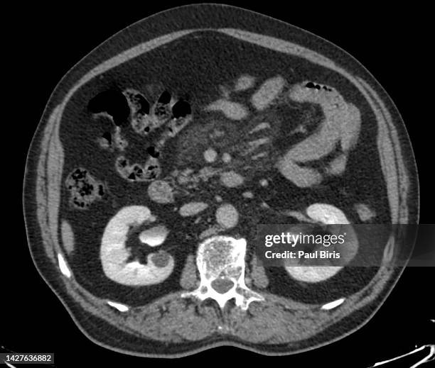 ct findings in sclerosing mesenteritis (panniculitis), axial view - mesentery stock pictures, royalty-free photos & images