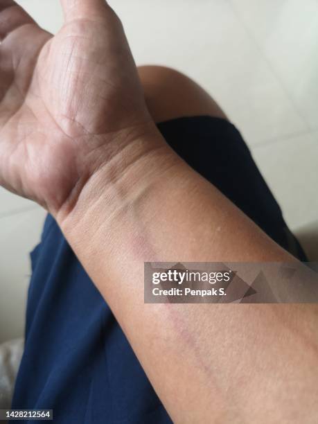 Scared Arm Scarred Arm Photos and Premium High Res Pictures - Getty Images