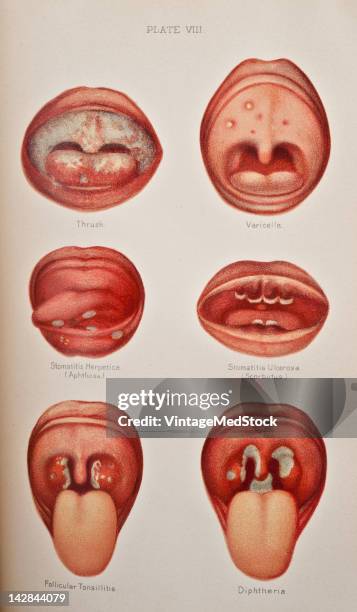 Medical illustration from 'A System of Genito-Urinary Diseases' depicts several dangerous infections: Thrush, Varicella, Stomatitis Herpetica,...