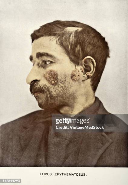 Medical photograph from 'Photographic Atlas of the Diseases of the Skin' illustrates Lupus Erythematosus, 1903.