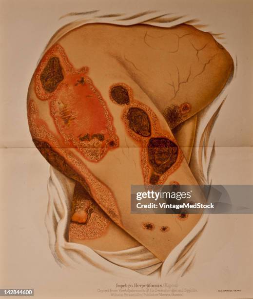 Medical illustration from 'Annual of the Universal Medical Sciences' depicts Impetigo Herpetiformis, 1888. The illustraion is copied from Wilhelm...