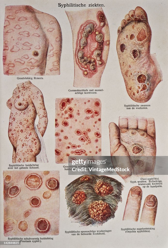 Syphilis II