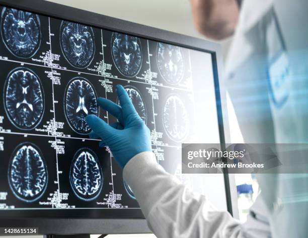 doctor analyzing patients brain scan on screen - dementie stockfoto's en -beelden
