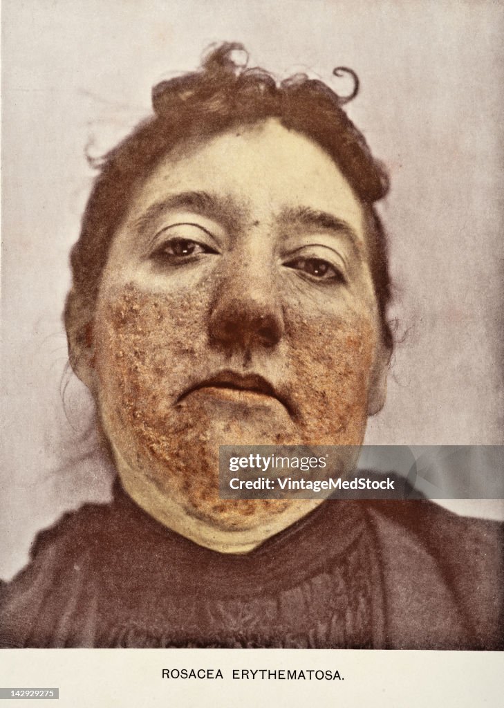 Rosacea Erythematosa