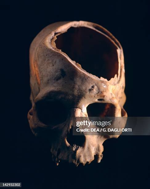 Skull showing the trepanation practiced by the Indians, from Peru. Pre-Inca Paracas Civilization, 6th Century BC. Lima, Museo Nacional De...