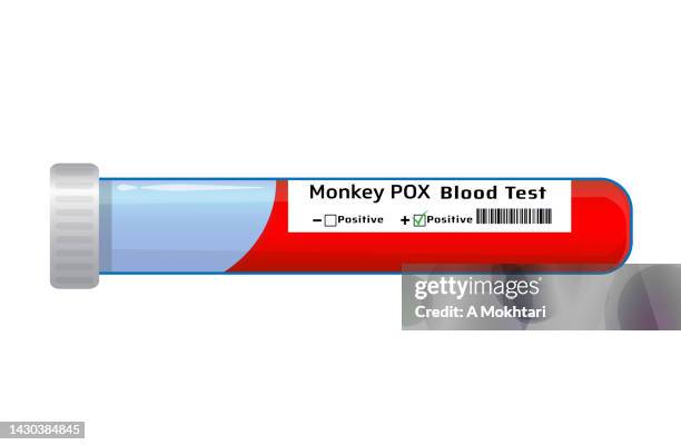 blood tube for monkeypox analysis, test and research. - smallpox virus stock illustrations