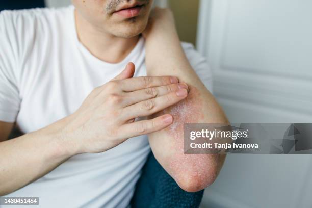 man who uses ointments, creams in the treatment of eczema, psoriasis and other skin diseases such as fungus, plaque, rash and spots. autoimmune genetic disease. - hautkrankheiten stock-fotos und bilder