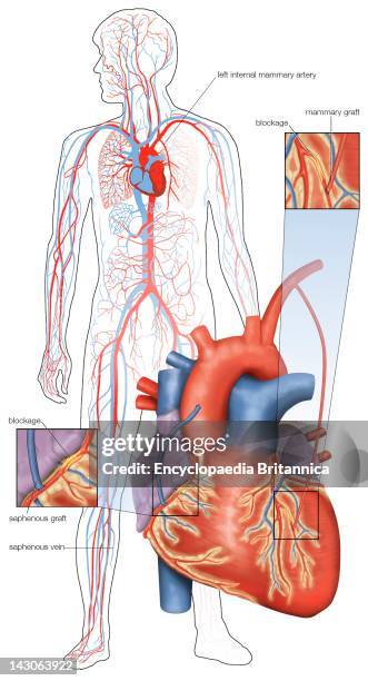 Diagram Of Double Coronary Artery Bypass Surgery.