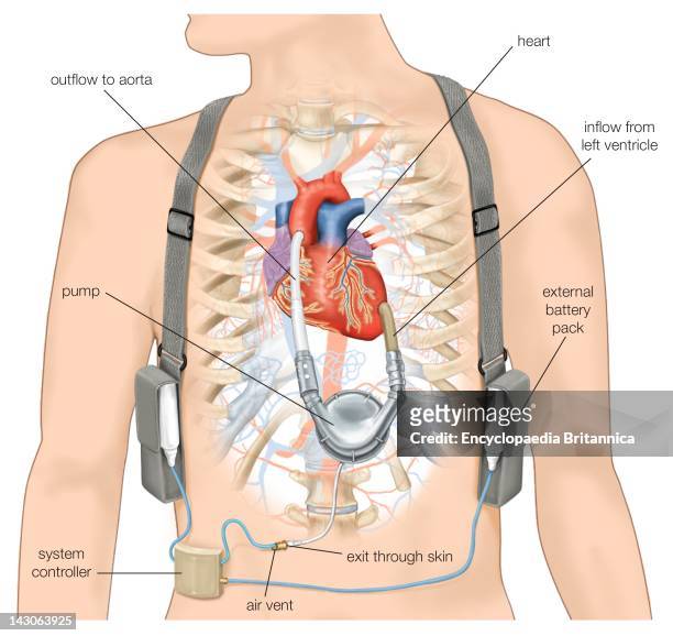 Ventricular Assist Device, An Artificial Heart That Helps Pump Oxygenated Blood Through The Aorta And To The Body'S Tissues.