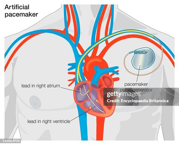 Foto Pacemaker Diagram Of An Artificial Pacemaker. Foto jornalística - Getty Images