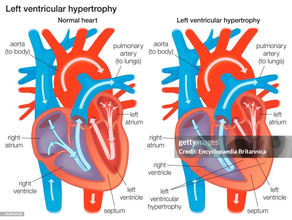 Cross Section Comparing The Left Ventricular Wall Of Normal Heart To A Left Ventricular Wall That Has Experienced Hypertrophy.