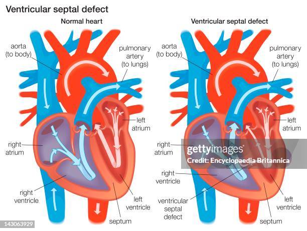 Comparison Of A Normal Heart To One With A Ventricular Septal Defect.