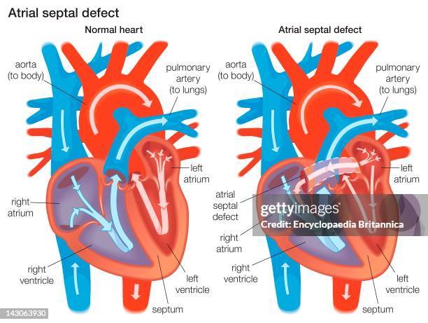 Diagram Demonstrating The Difference Between A Normal Heart And A Heart With An Atrial Septal Defect.