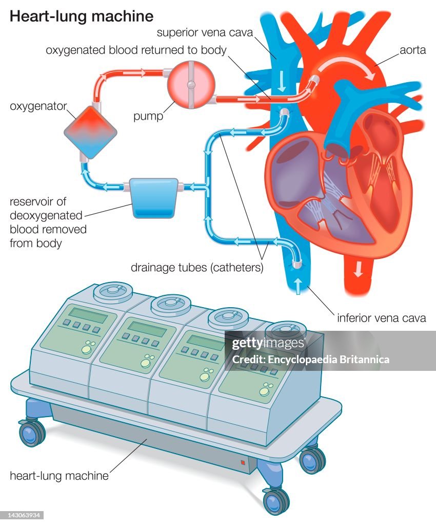 Heart Lung O2 A Heart-Lung Machine Diverts Blood From The Body To An Oxygenator ...