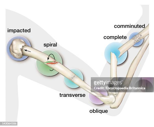 Types Of Fractures Of Bones.