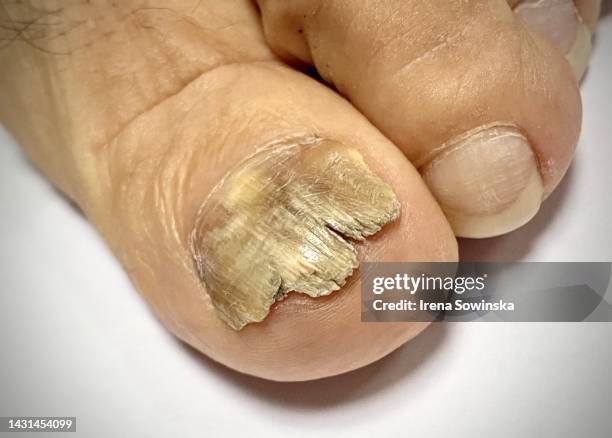 onicomicosi - onychomycosis stock pictures, royalty-free photos & images