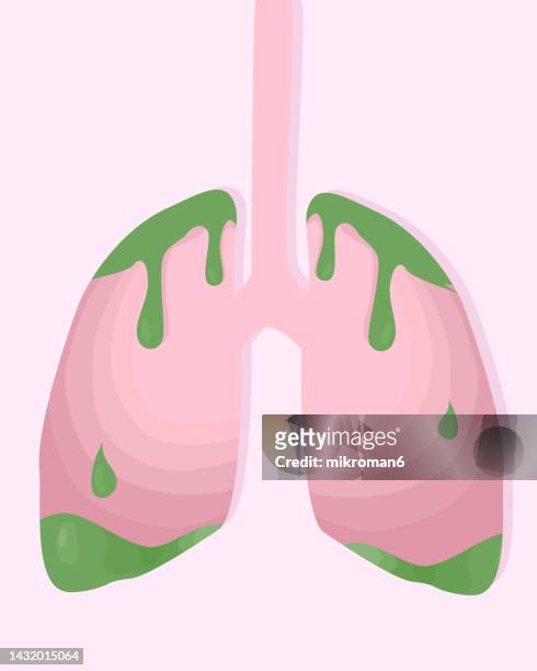 vector of infected lungs with virus or bacteria. there is a sickness inside the lungs visible in the image - stomach vector stock pictures, royalty-free photos & images