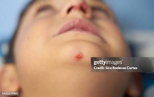 impetigo sores that form in a wound on the nose and chin - impetigo stock-fotos und bilder