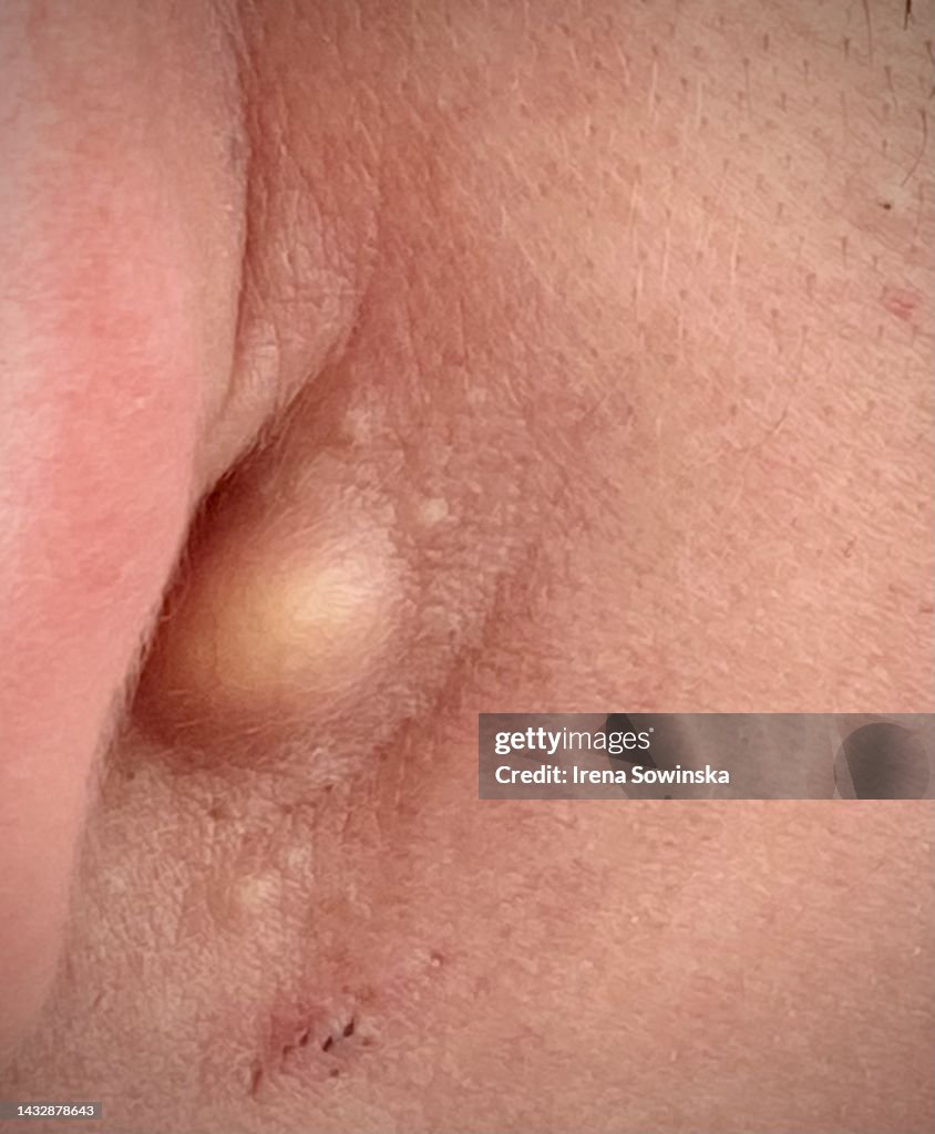 Sebaceous cyst