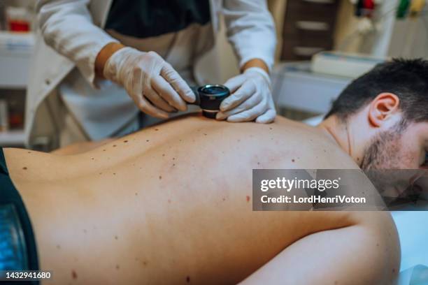 dermatologist inspecting patient skin moles - mole stockfoto's en -beelden