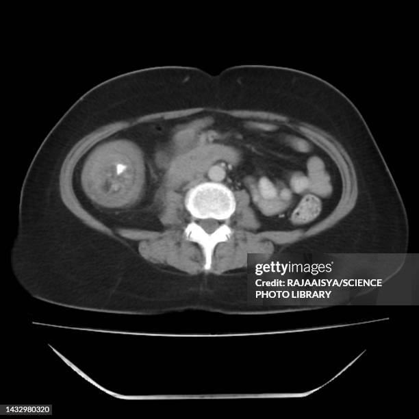 Intestinal Ct Intestinal Scan Photos and Premium High Res Pictures - Getty Images