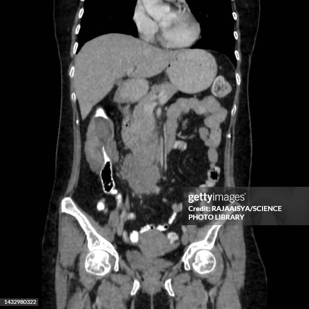 Colon Intesseption 257 Bowel Obstruction Stock Photos, High-Res Pictures, and Images ...